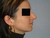 rhinoplastie